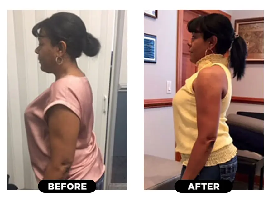 Avanti Body Weight Loss Program Before and After Photo
